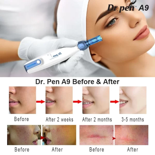 dr. pen a9 ultima microneedling przed i po